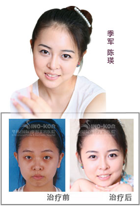 陳瑛頦部填充前后對比照片