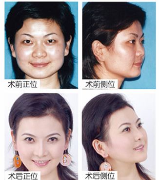 湯永花去眼袋前后對比照片