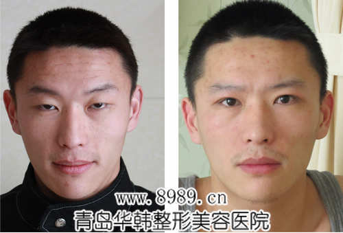 陽光上瞼下垂矯正前后對(duì)比照片