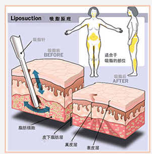小腿吸脂減肥管用嗎