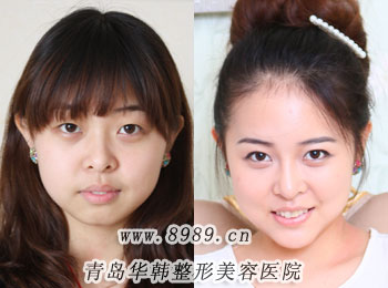 青島雙眼皮修復(fù)要多少錢