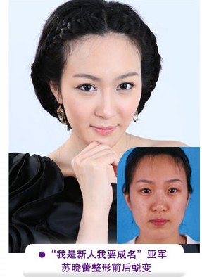 蘇曉蕾雙眼皮整形成功前后對比照片