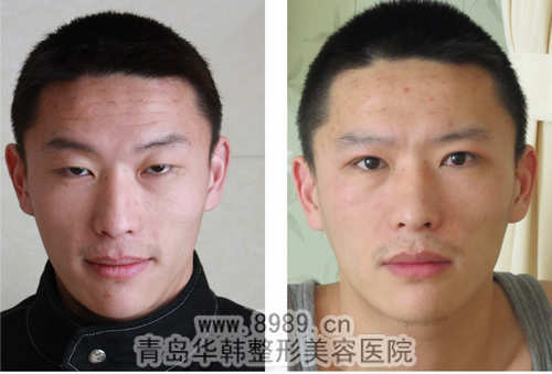 陽光激光祛額頭皺紋前后對比照片