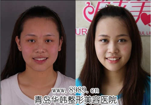 劉云冷光牙齒美白前后對比照片