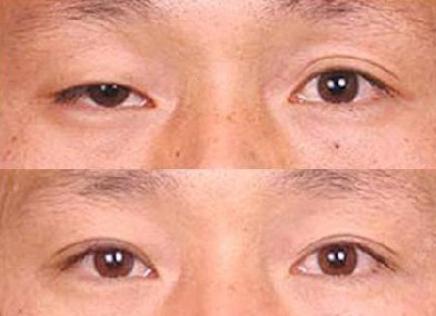 上瞼下垂矯正前后對(duì)比照片