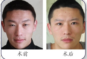 陽光上瞼下垂矯正前后對比照片
