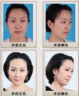 蘇曉蕾雙眼皮整形成功前后對比照片