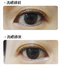 激光洗眼線前后對比照片