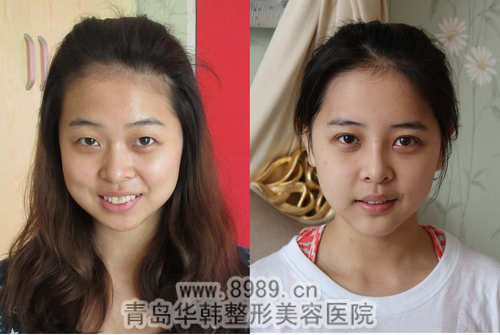 陳瑛鼻中隔軟骨隆鼻前后對比照片