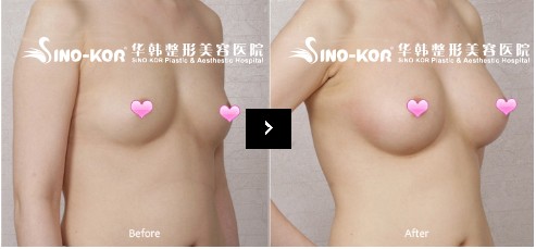 三維水滴隆胸前后對(duì)比照片
