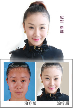 賈蓉紋唇前后對(duì)比照片