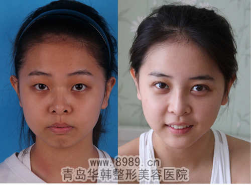 陳瑛耳軟骨墊鼻尖前后對比照片