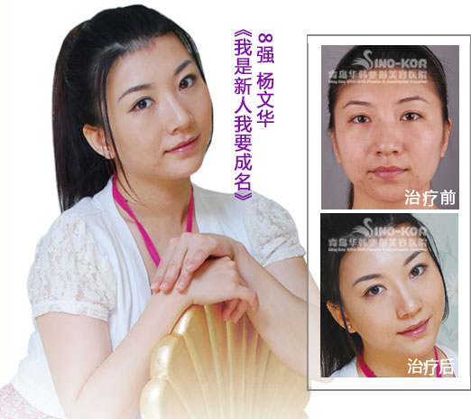 楊文華光子祛痘前后對(duì)比照片