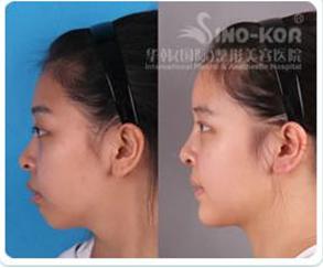 陳瑛鼻孔縮小整形前后對(duì)比照片