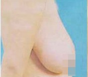 乳房下垂矯正前后對(duì)比照片