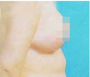 乳房下垂矯正前后對(duì)比照片