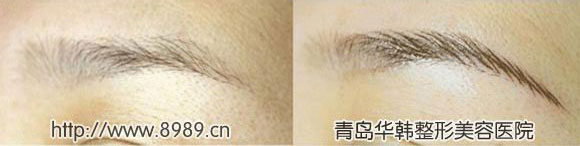 紋眉前后對(duì)比照片