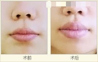 青島薄唇變厚的價(jià)格貴嗎