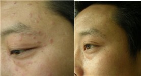 賽諾秀去扁平疣前后對(duì)比照片