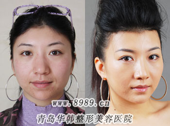 楊文華做高顴骨整形前后對比照片