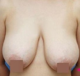 巨乳縮小整形前后對(duì)比照片