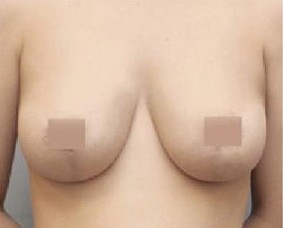 巨乳縮小整形前后對(duì)比照片