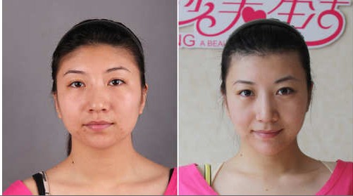 楊文華做顴骨內(nèi)推整形前后對比照片