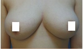 巨乳縮小整形前后對比照片