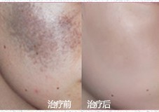 褐青斑