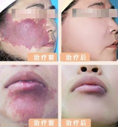 紅胎記對比