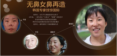 無鼻女再造鼻專題圖