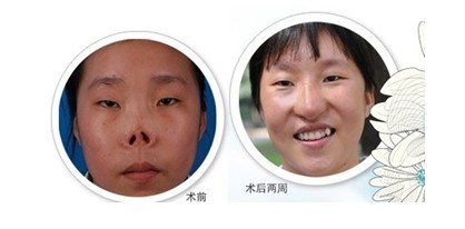 徐壽紅鼻部再造手術(shù)前后對比圖