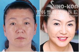 李東風(fēng)除皺前后對比圖