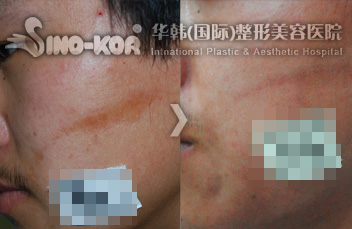 疤痕修復(fù)效果前后對比圖