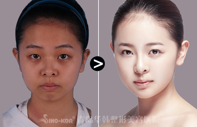 豐下巴美容效果對比