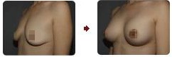 乳房下垂矯正效果前后對比