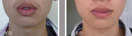 嘴唇變薄效果前后對比圖