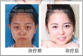 嫩膚效果前后對(duì)比圖