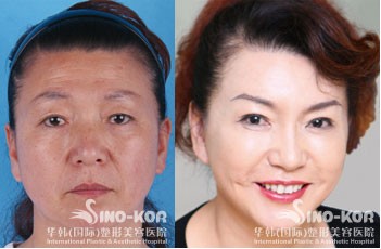 除皺美容效果前后對比