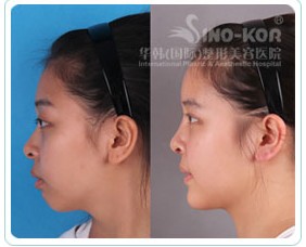 假體隆鼻整形效果前后對比