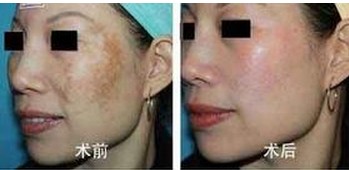 黃褐斑治療效果前后對比圖