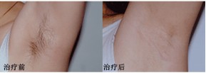 腋下脫毛效果前后對比圖