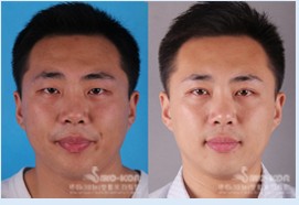 吸脂塑型效果前后對(duì)比圖