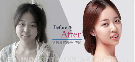 激光美膚效果